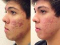 /album/acne-before-and-after/acne-before-and-after-2-jpg/